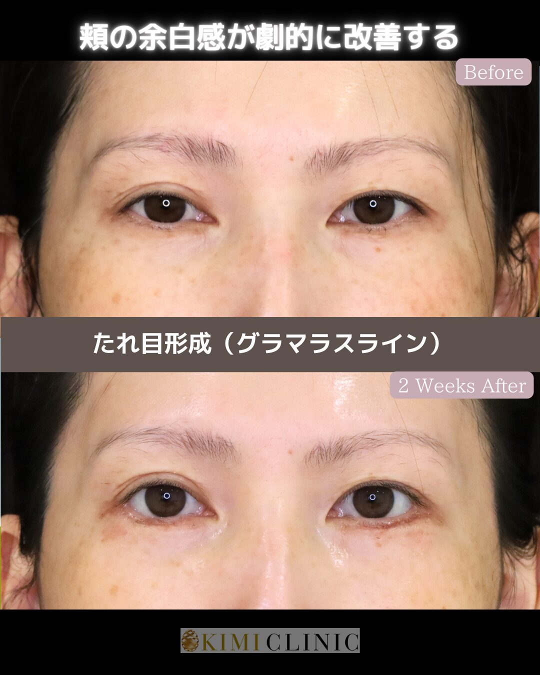 「たれ目形成（グラマラスライン）」の術前・術後比較Before写真