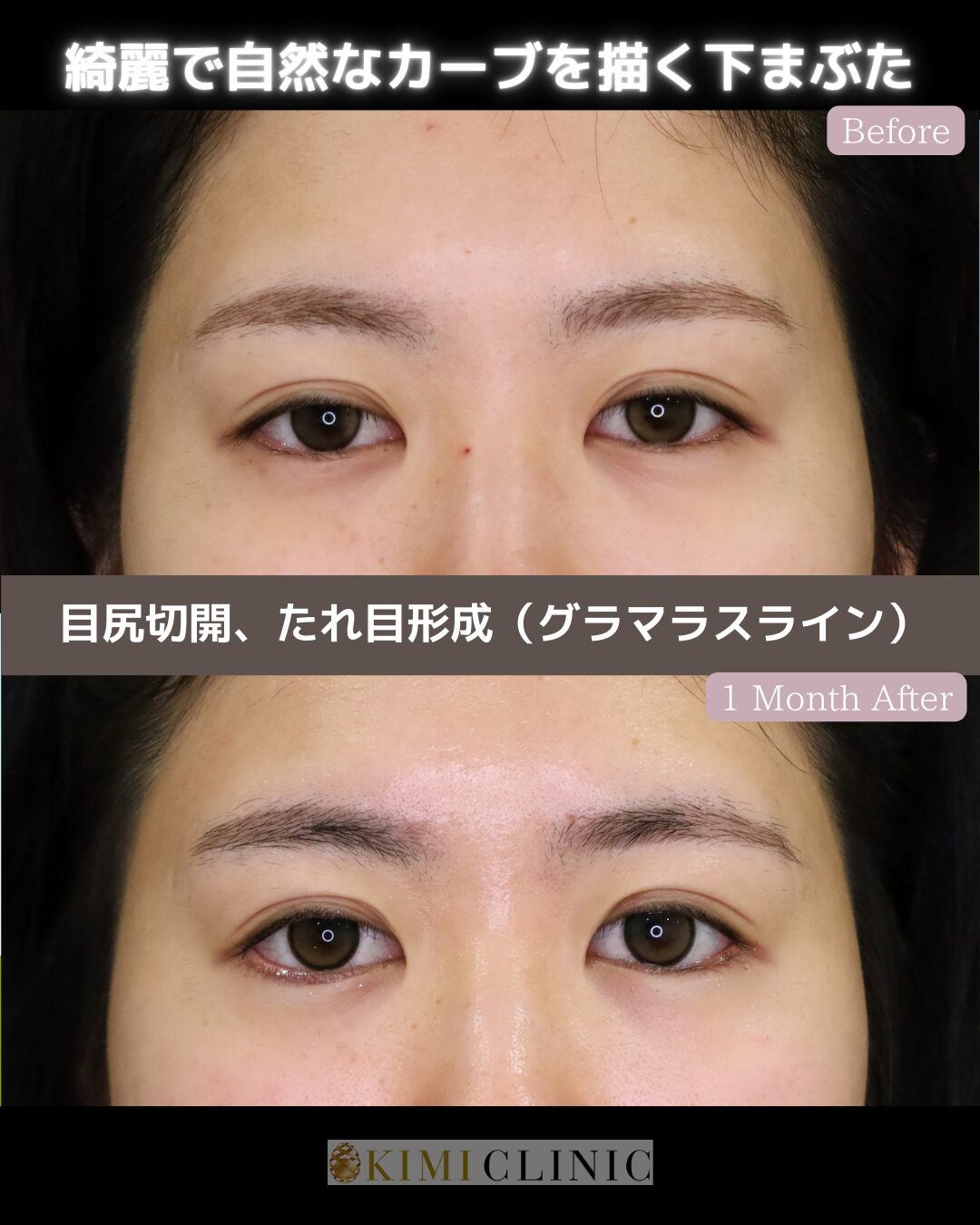 「目尻切開・たれ目形成（グラマラスライン）」の術前・術後比較Before写真