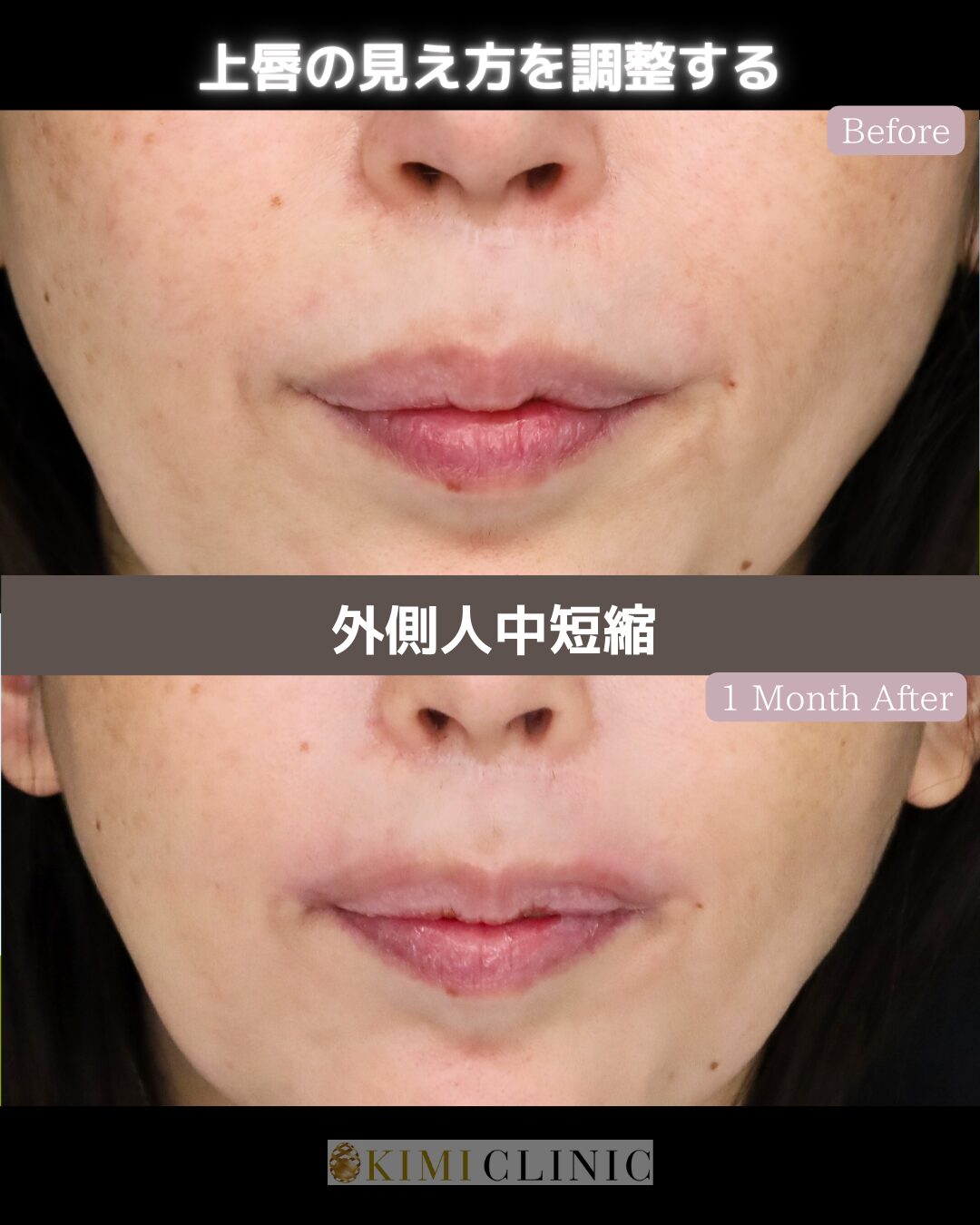 「外側人中短縮」の術前・術後比較Before写真