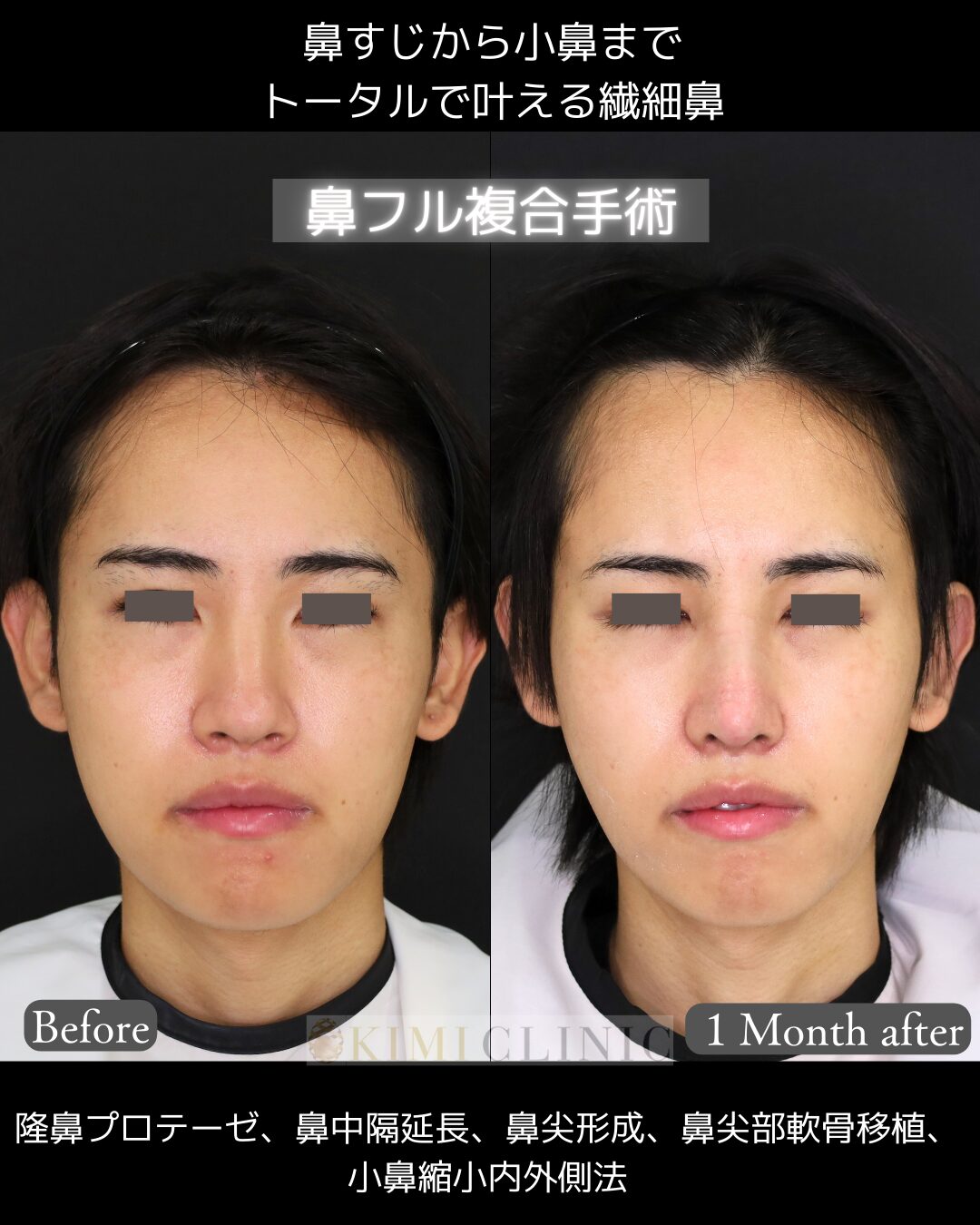 「鼻フル複合手術」の術前・術後比較Before写真