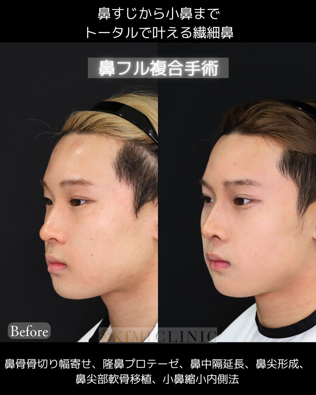 「鼻フル複合手術」の術前・術後比較Before写真