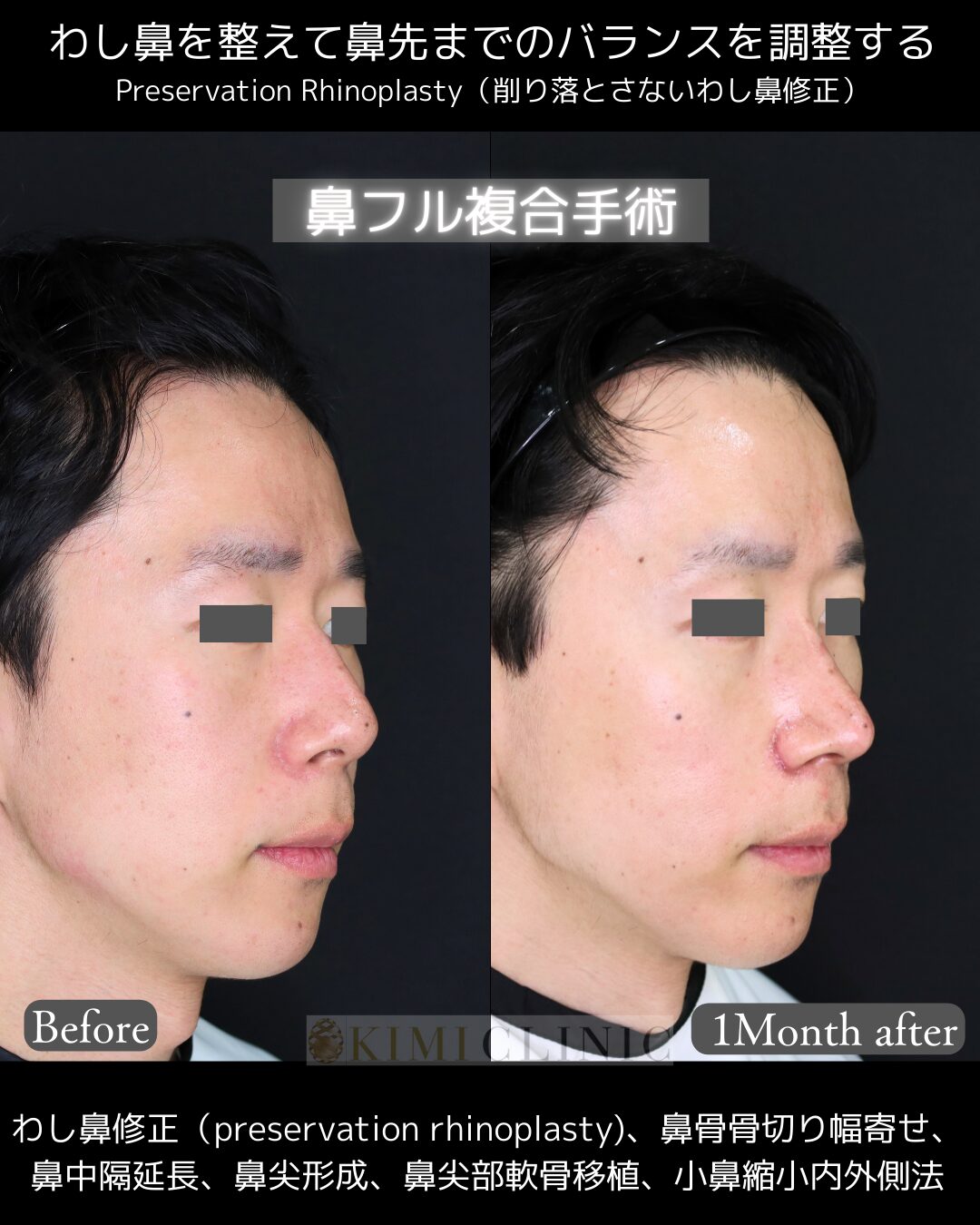 「鼻フル複合手術」の術前・術後比較Before写真