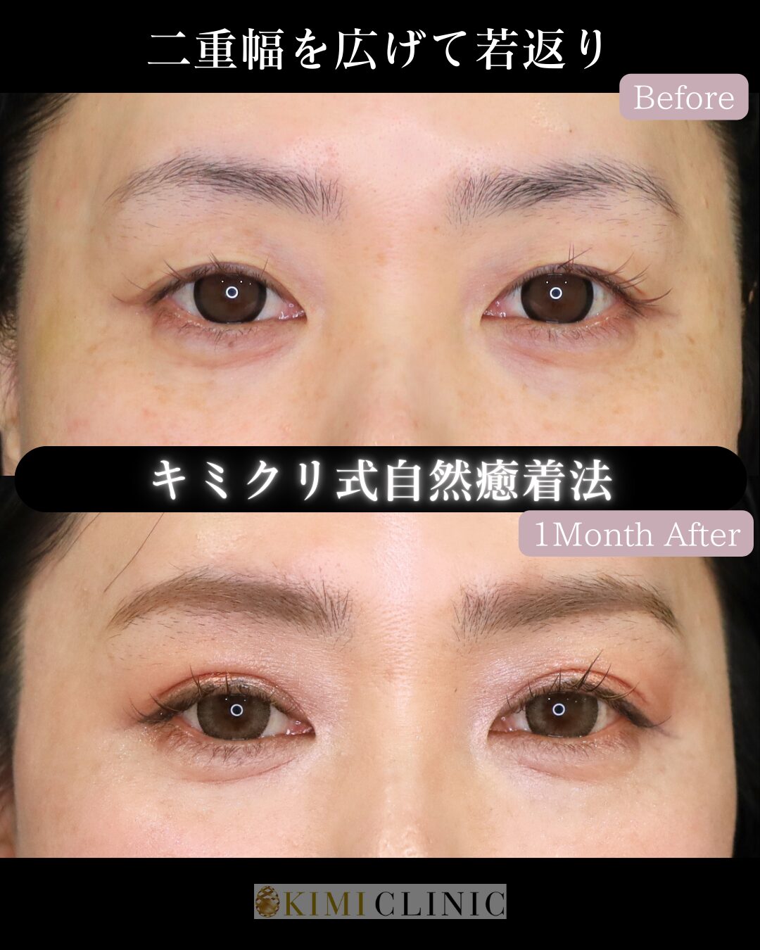 「キミクリの自然癒着法」の術前・術後比較Before写真