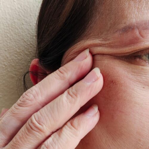 “たるみ治療”でお悩みの方必見！層別たるみ治療について解説します