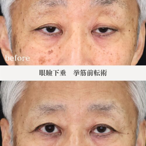 【眼瞼下垂　症例紹介】～瞼の重み、それ眼瞼下垂じゃないですか？～