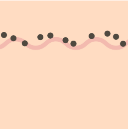 境界母斑（きょうかいぼはん）