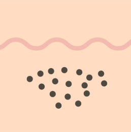 真皮内母斑（しんぴないぼはん）