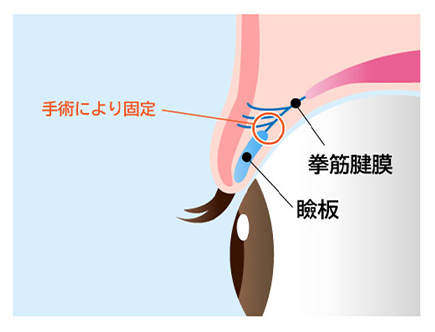 挙筋腱膜前転法（保険診療）