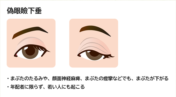 偽性眼瞼下垂（眼瞼皮膚弛緩症）