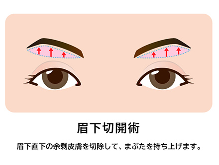 眉毛下皮膚切除法（保険診療）