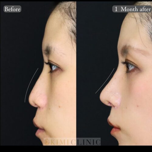 【症例解説】メリハリがなくさみしい印象の鼻を、人工物を使わずナチュラルな立体感のある鼻へ✨