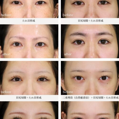 【症例集　たれ目形成術】