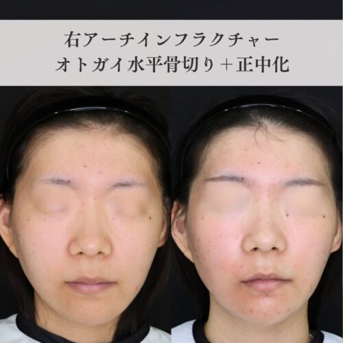 【症例解説】左右差のある輪郭を整え、自然で美しいフェイスラインへ― 右アーチインフラクチャー＆オトガイ形成術症例 ―