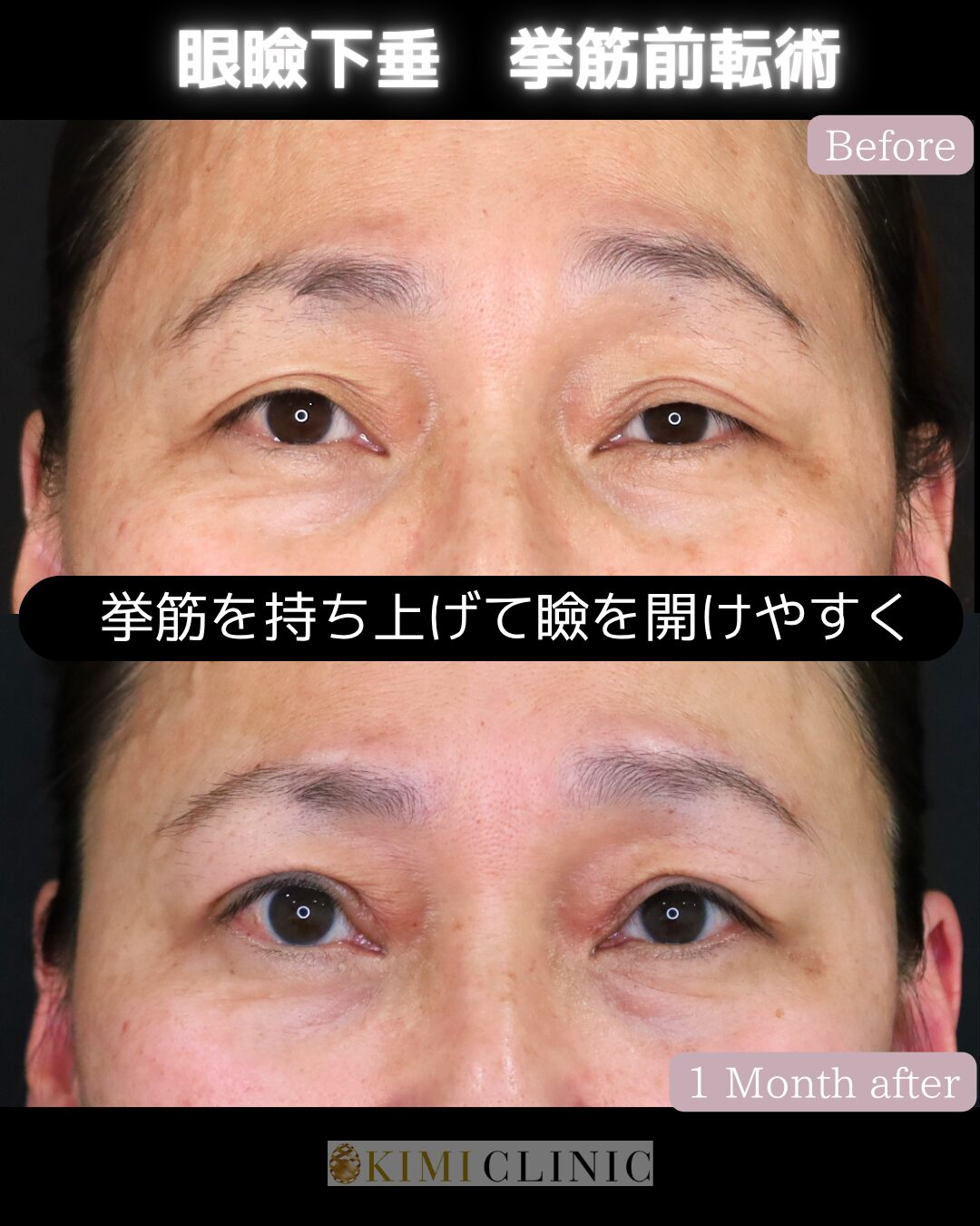 「老人性眼瞼下垂に対する眼瞼下垂手術」の術前・術後比較Before写真