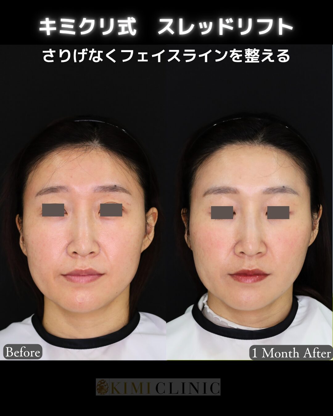 「キミクリ式糸リフト」の術前・術後比較Before写真