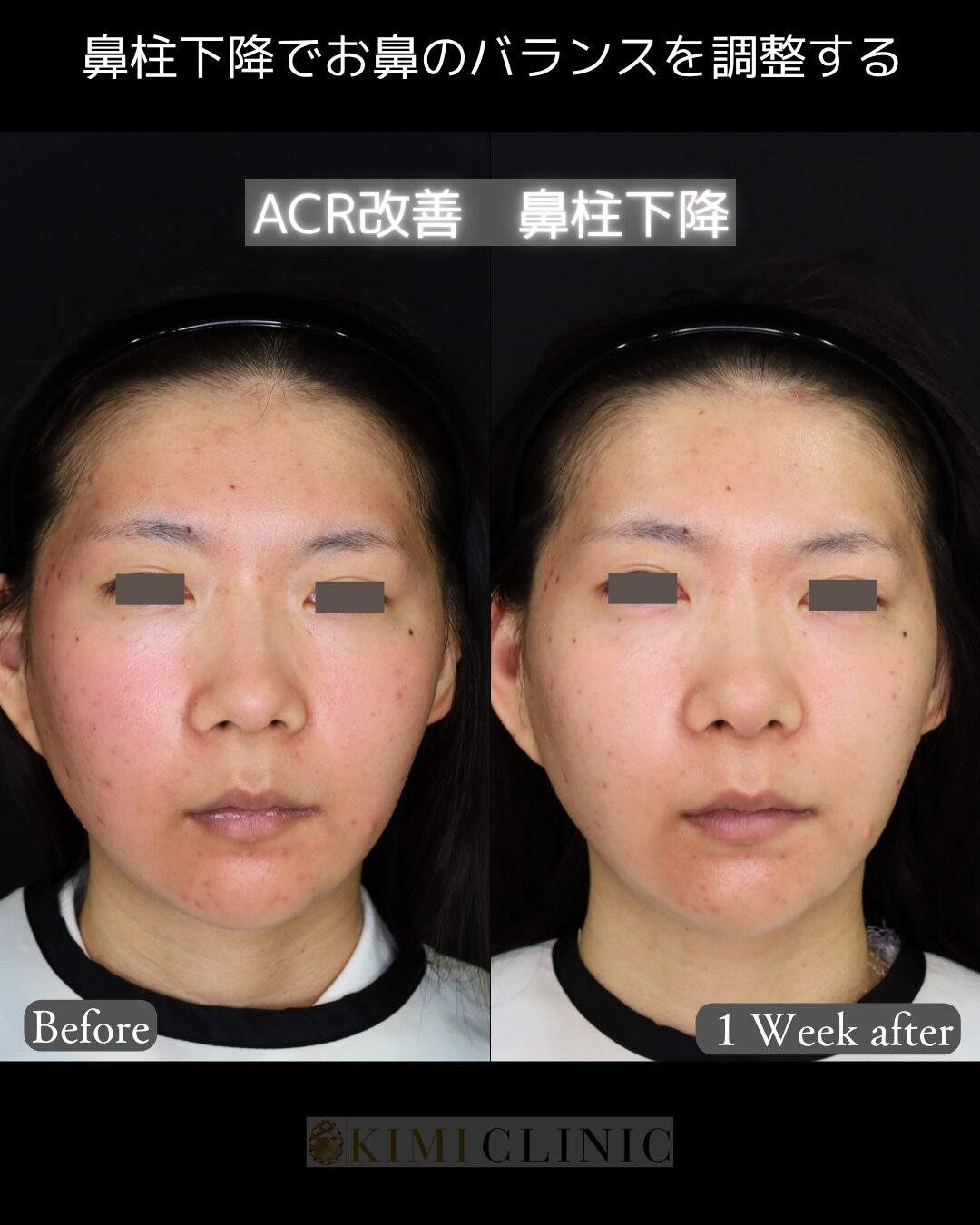 「鼻柱下降」の術前・術後比較Before写真