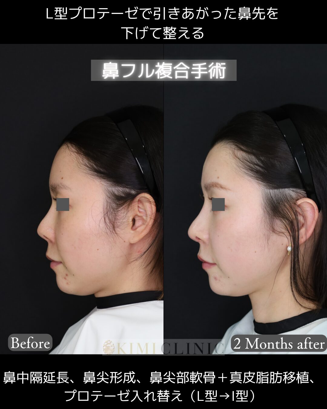 「プロテーゼ入れ替え・鼻フル複合手術」の術前・術後比較Before写真