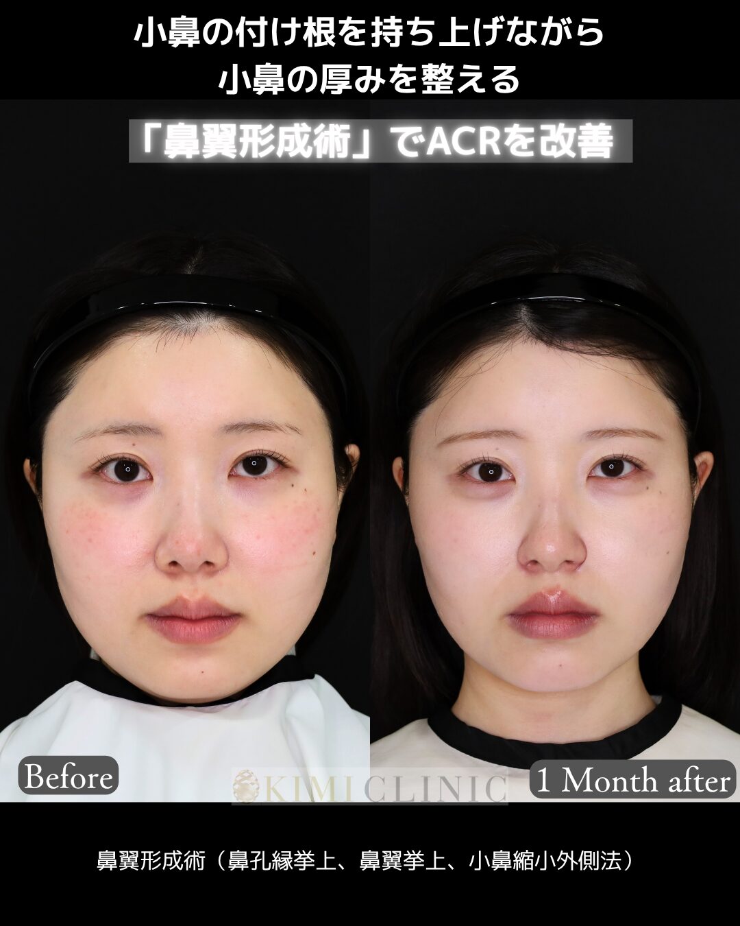 「鼻翼形成術（小鼻の複合手術）」の術前・術後比較Before写真