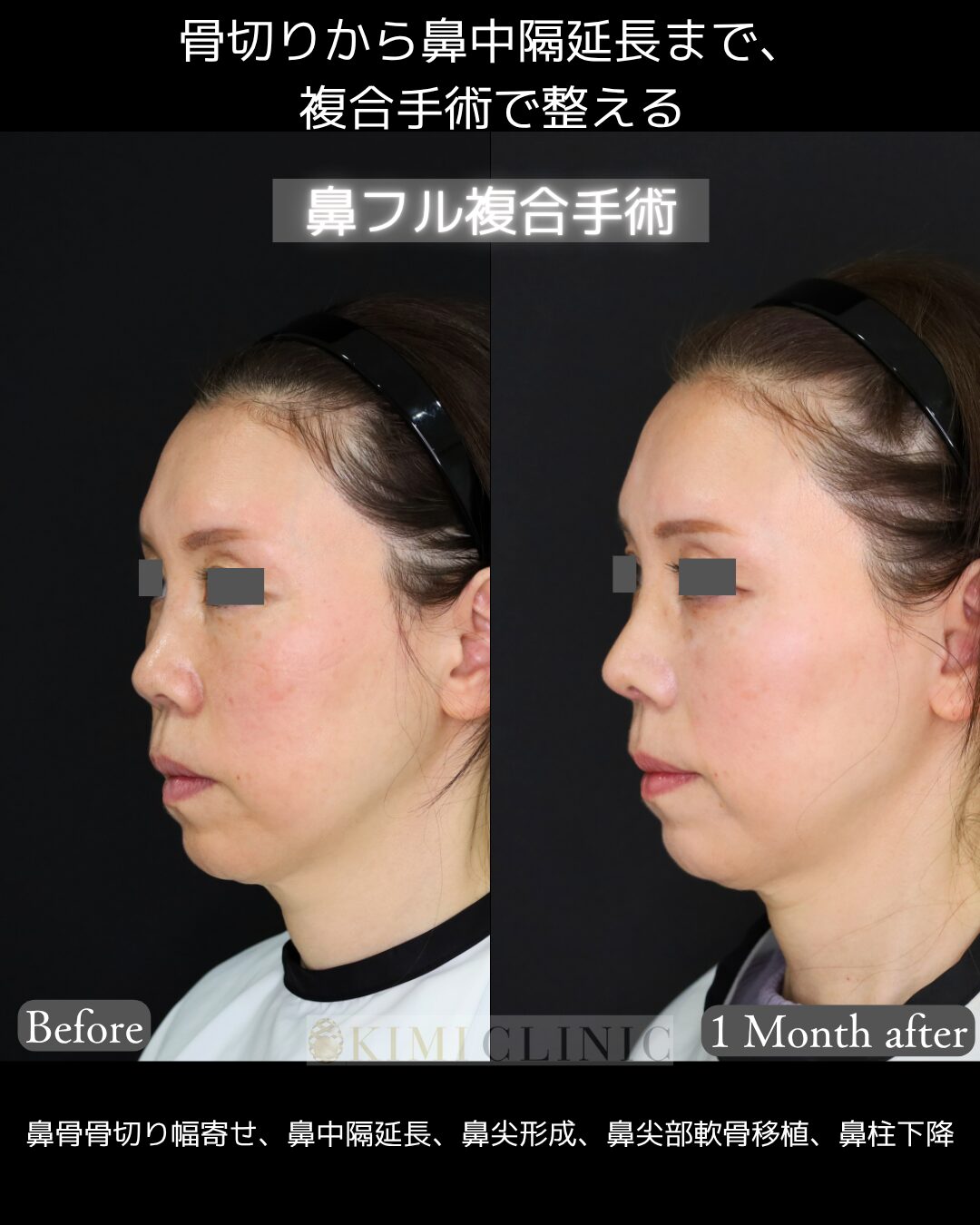 「鼻フル複合手術」の術前・術後比較Before写真