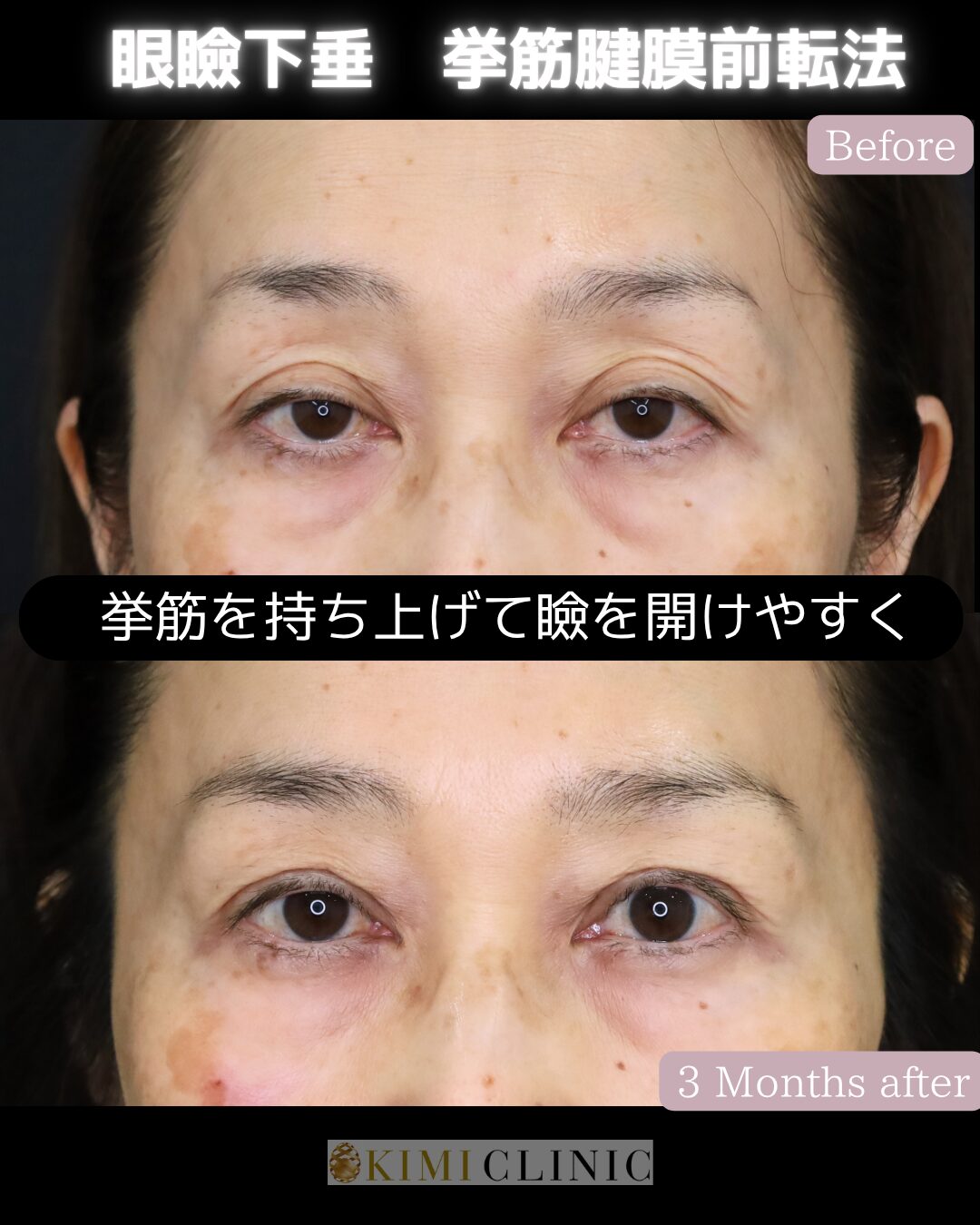 「老人性眼瞼下垂に対する眼瞼下垂手術」の術前・術後比較Before写真