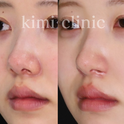 ACRを整える鼻翼形成術✨一石三鳥✨の手術で理想のお鼻へ