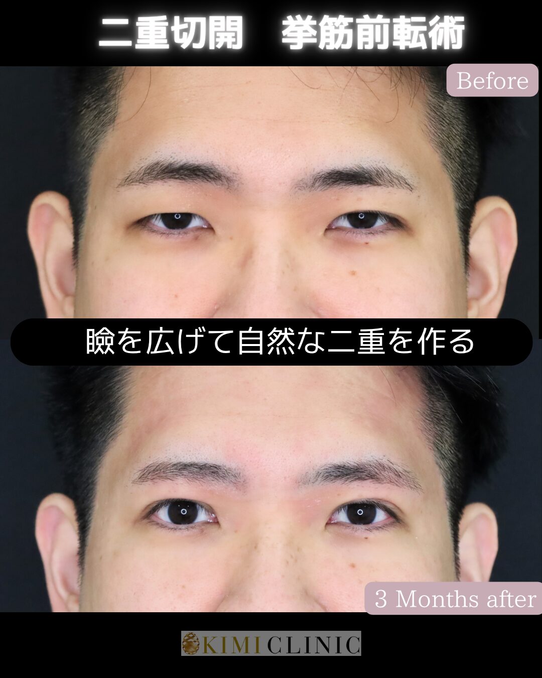 「二重切開（眼瞼下垂手術）」の術前・術後比較Before写真