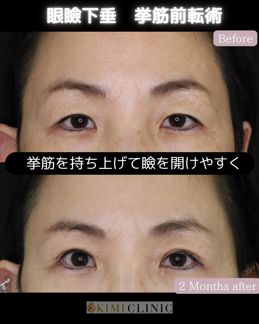 「老人性眼瞼下垂に対する眼瞼下垂手術」の術前・術後比較Before写真