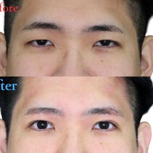 ≪男性の二重整形≫全切開＋挙筋前転術＋ROOF切除で自然なのに目力アップでかっこよく垢ぬける👀✨