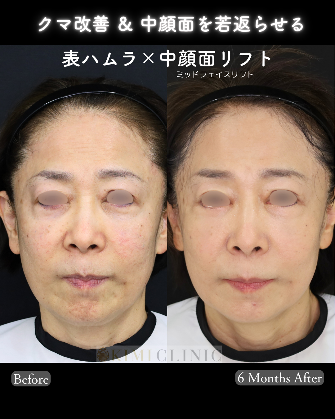 「表ハムラ × 中顔面（ミッドフェイス）リフト」の術前・術後比較Before写真