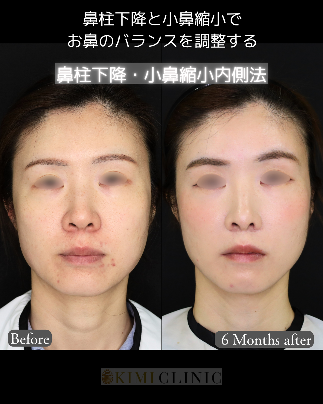 「鼻柱下降×小鼻縮小（内側法）」の術前・術後比較Before写真