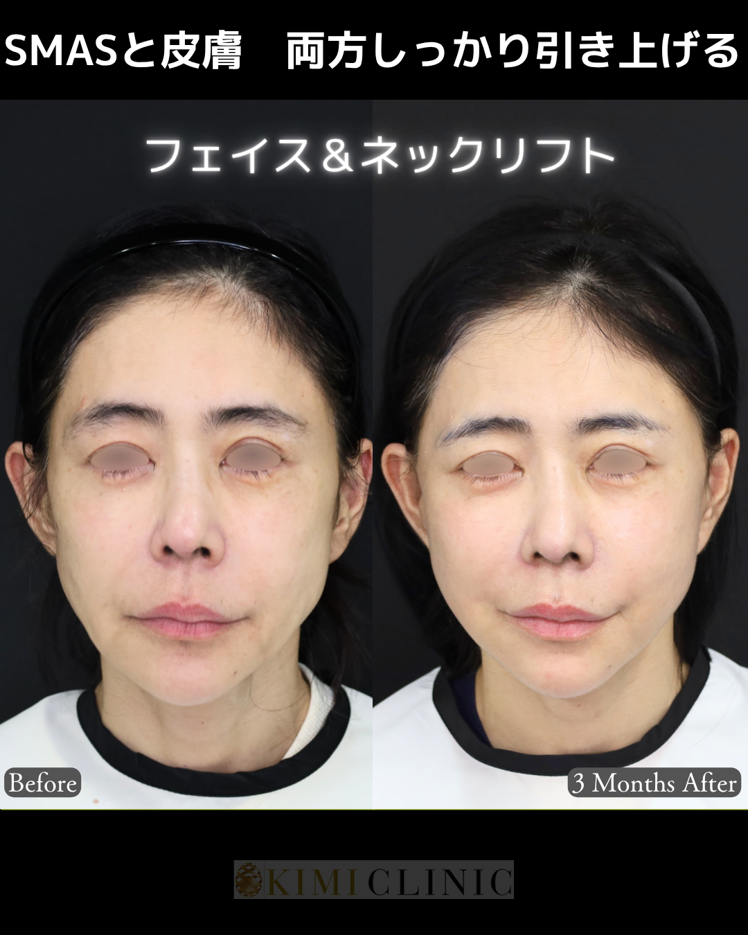「フェイス＆ネックリフト」の術前・術後比較Before写真