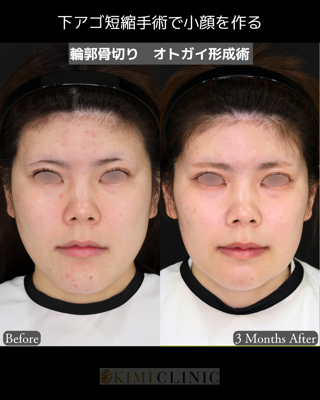 「オトガイ形成術（輪郭骨切り）」の術前・術後比較Before写真