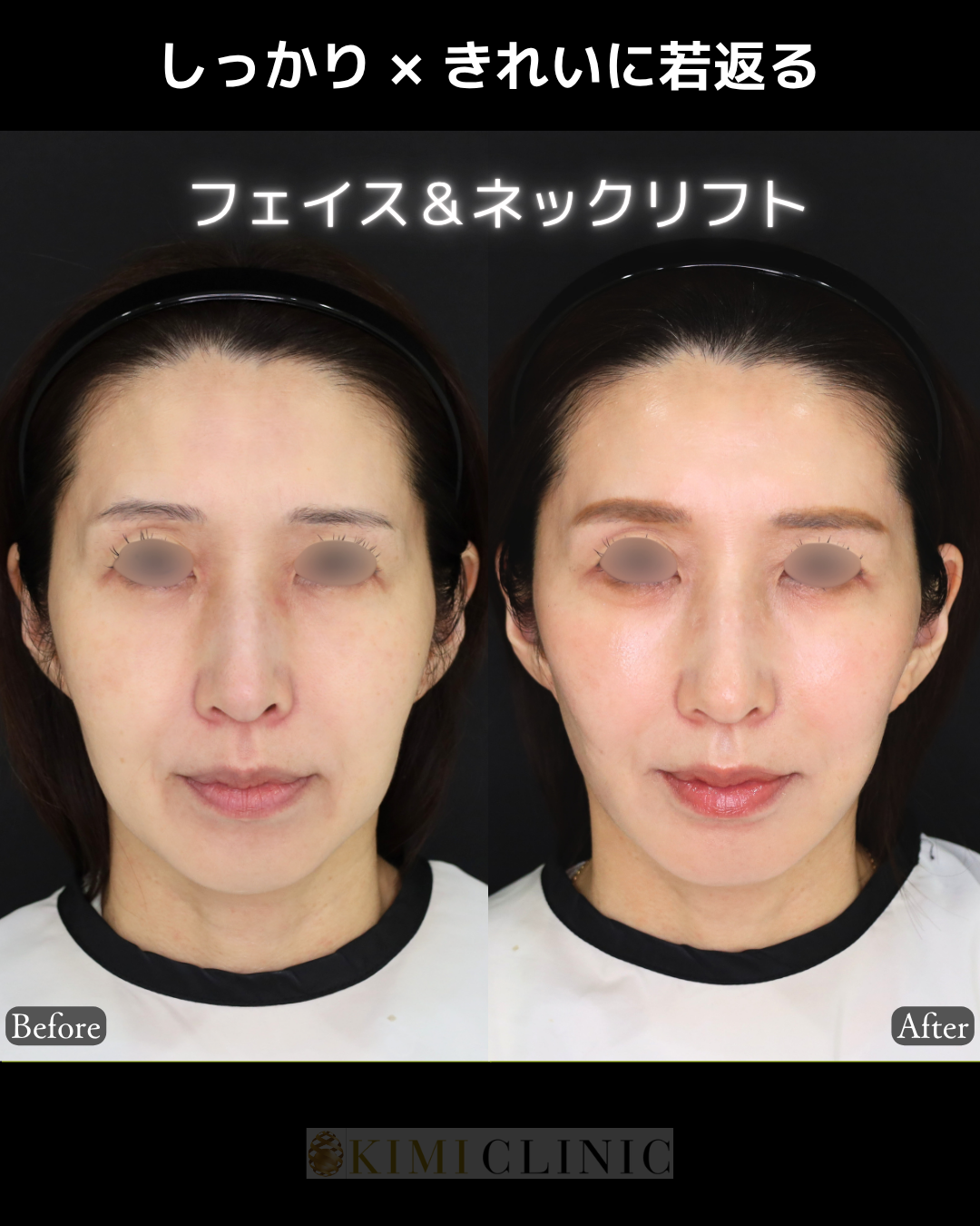 「フェイス＆ネックリフト」の術前・術後比較Before写真