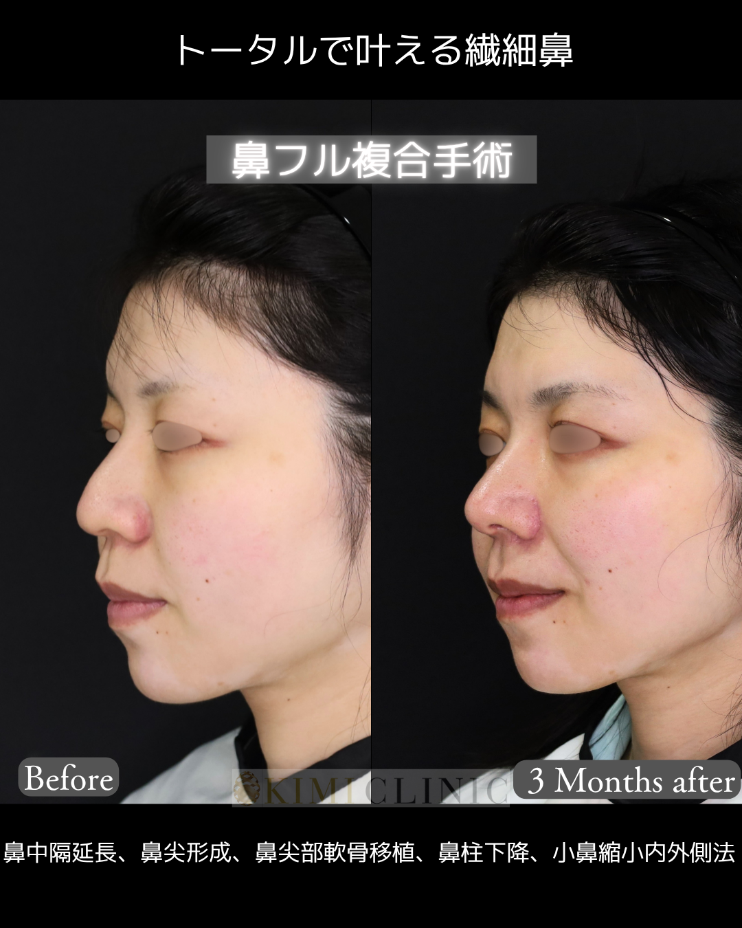 「鼻フル複合手術」の術前・術後比較Before写真