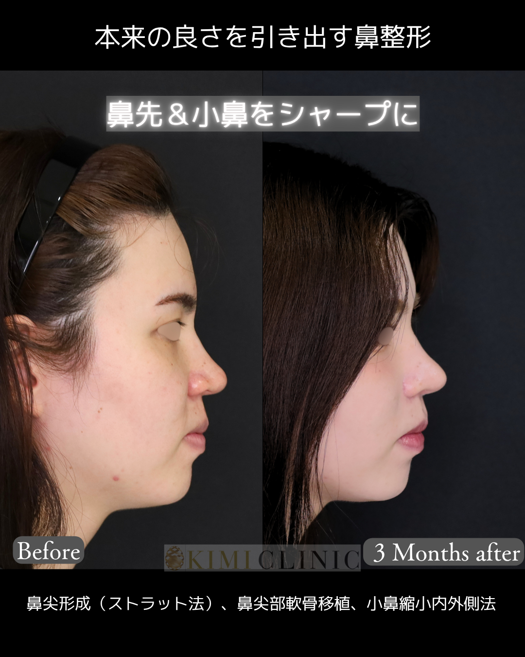 「鼻フル複合手術」の術前・術後比較Before写真
