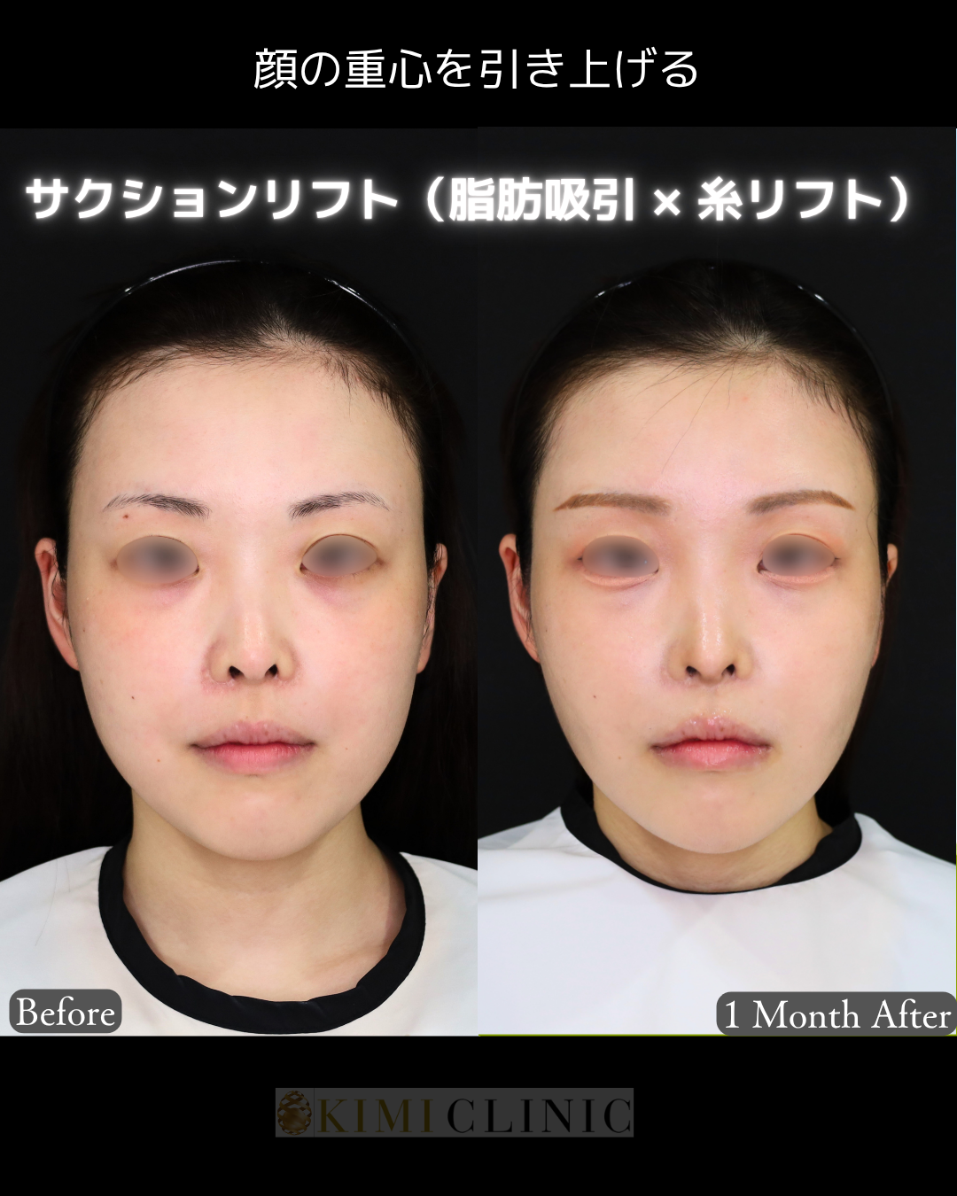 「サクションリフト（脂肪吸引×糸リフト）」の術前・術後比較Before写真