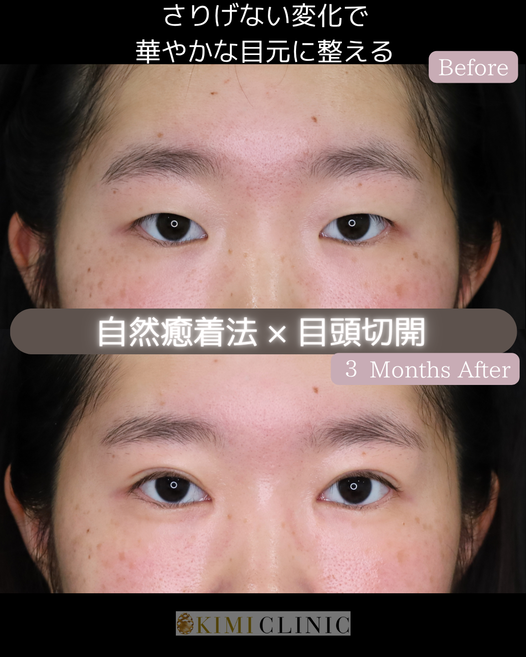 「自然癒着法×目頭切開」の術前・術後比較Before写真