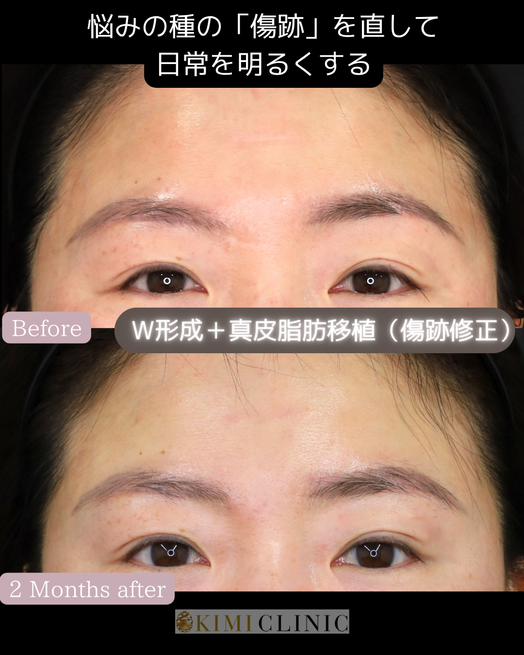 「傷跡修正（W形成術・真皮脂肪移植）」の術前・術後比較Before写真