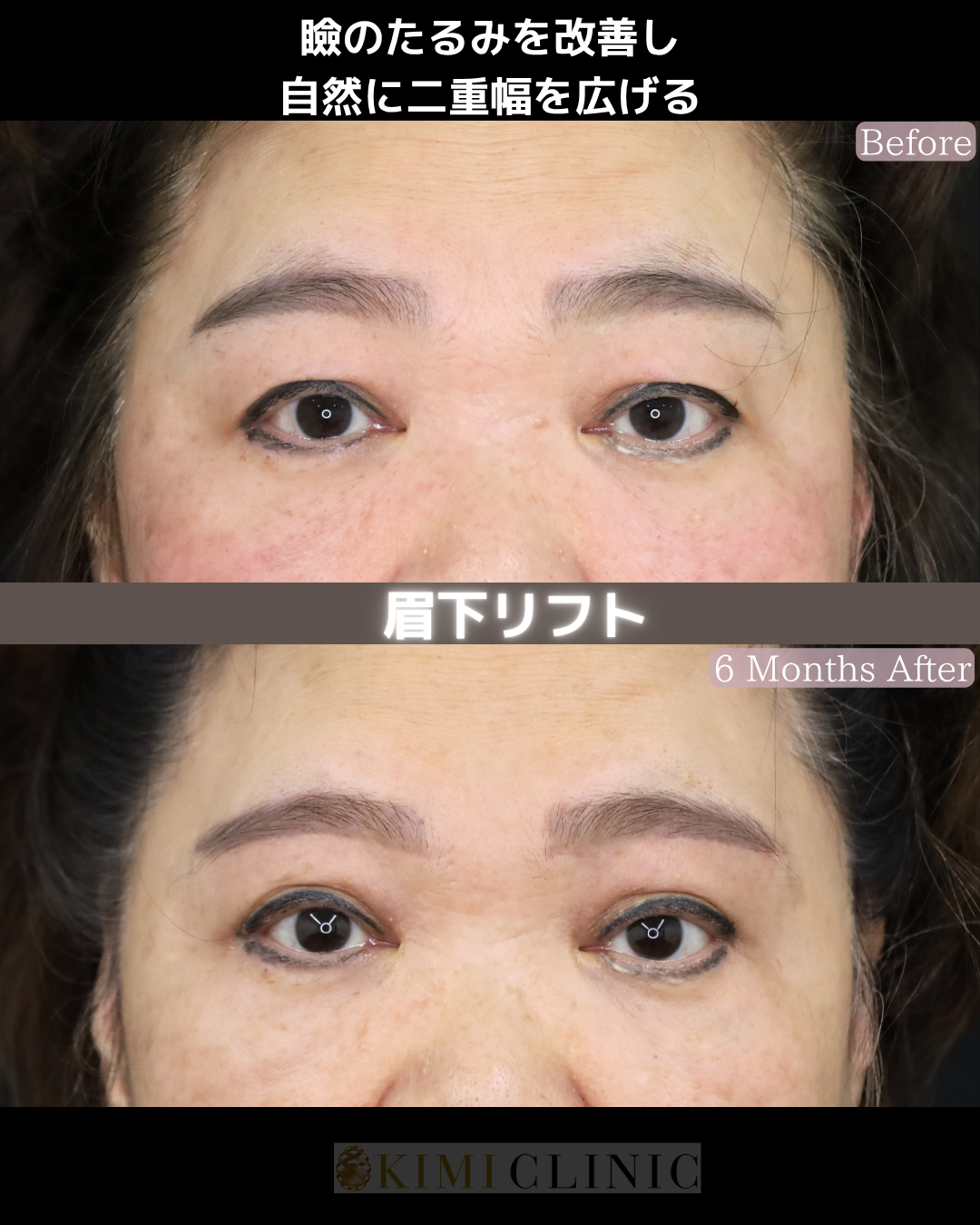 「眉下切開（眉下リフト）」の術前・術後比較Before写真