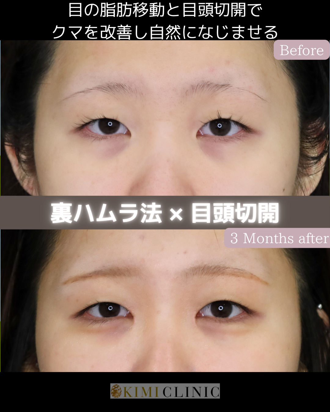「裏ハムラ法 × 目頭切開」の術前・術後比較Before写真