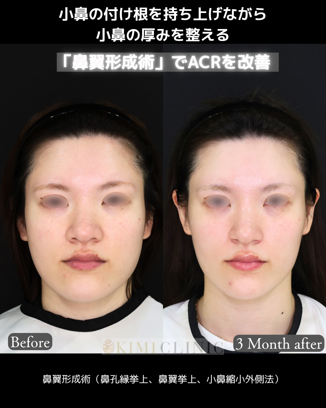 「鼻翼形成術（小鼻の複合手術）」の術前・術後比較Before写真