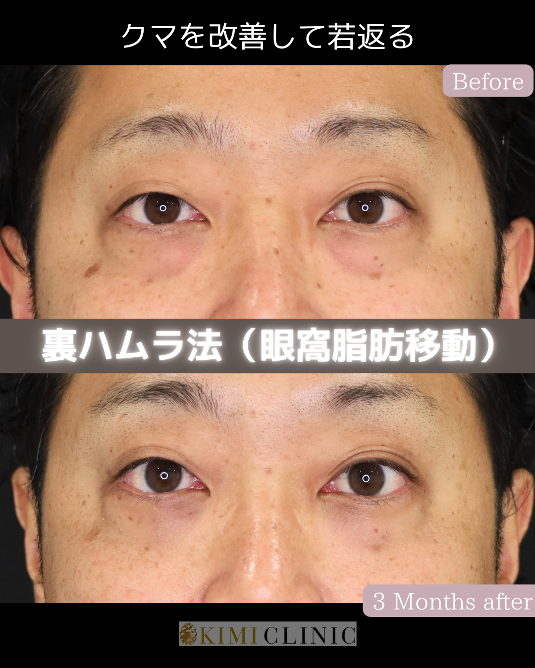 「裏ハムラ法」の術前・術後比較Before写真