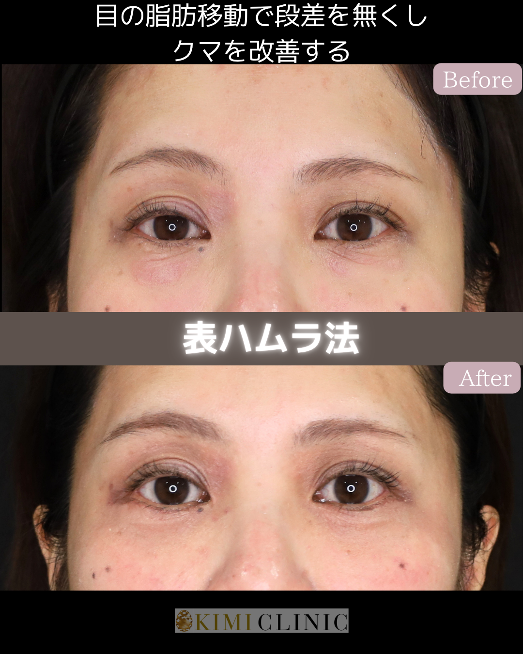 「表ハムラ法」の術前・術後比較Before写真