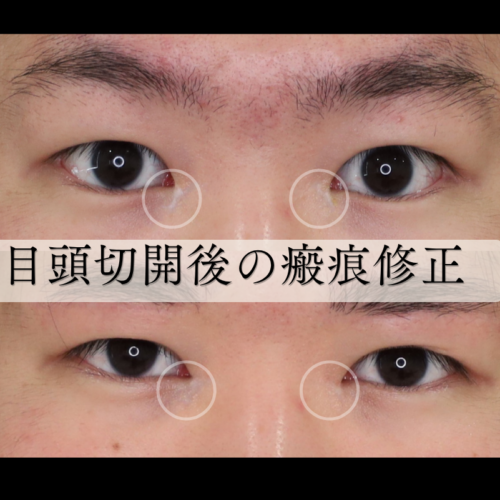 【瘢痕修正】目頭切開後の”傷跡(＝瘢痕)とくぼみ”を”瘢痕形成と真皮脂肪移植”で目立ちにくく✨