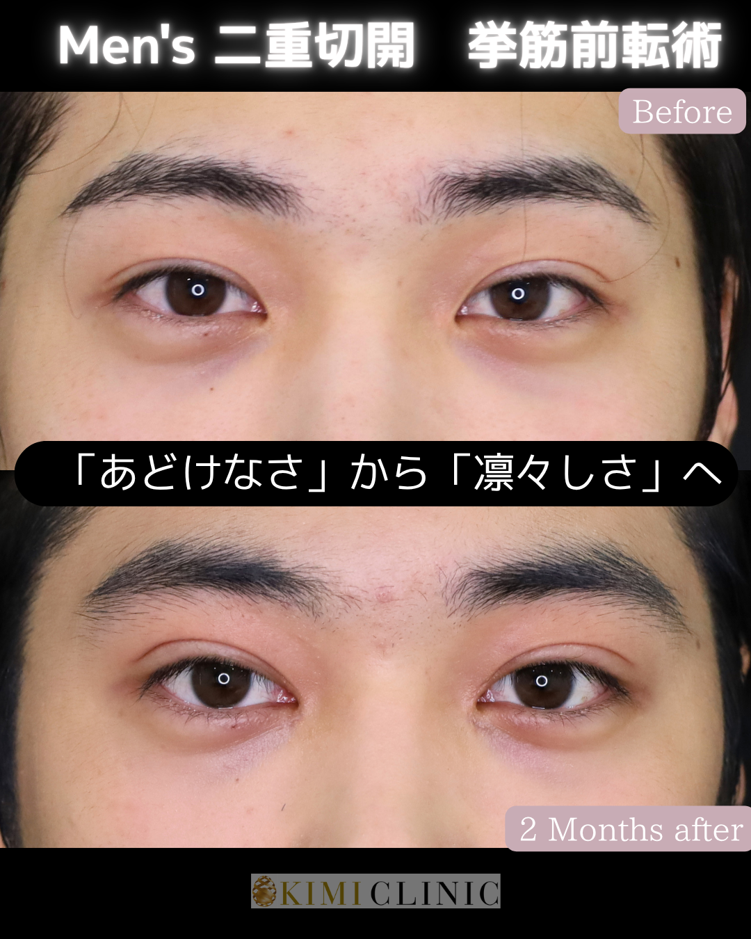 「二重切開（挙筋前転術）」の術前・術後比較Before写真