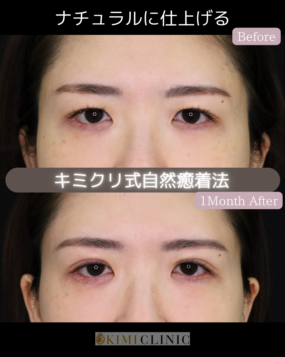 「キミクリの自然癒着法」の術前・術後比較Before写真