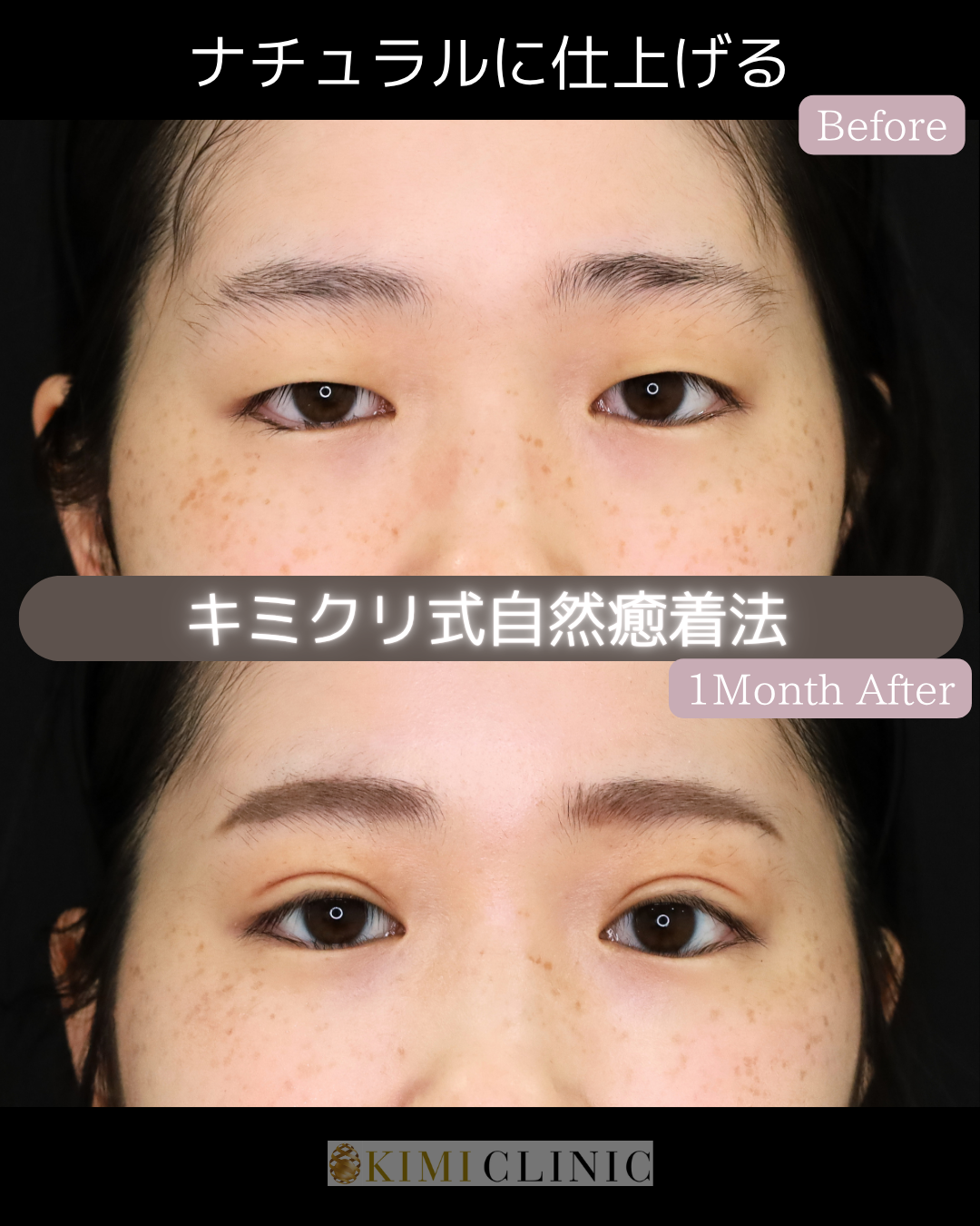 「キミクリの自然癒着法」の術前・術後比較Before写真