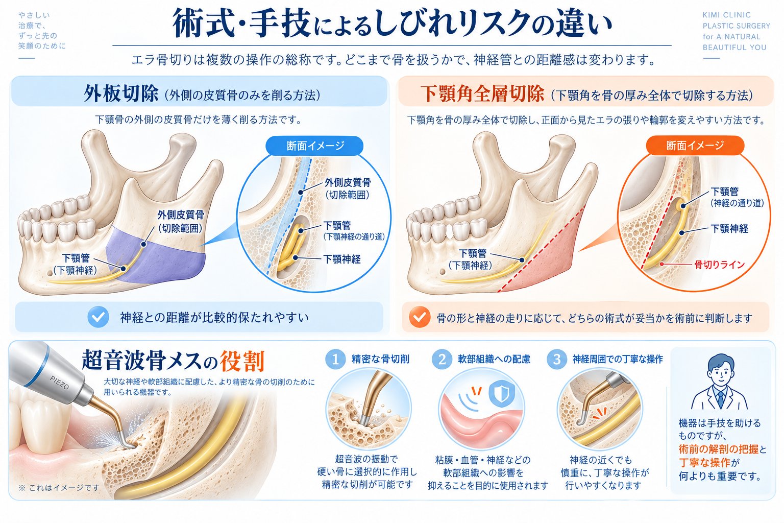 術式・手技によるしびれリスクの違い