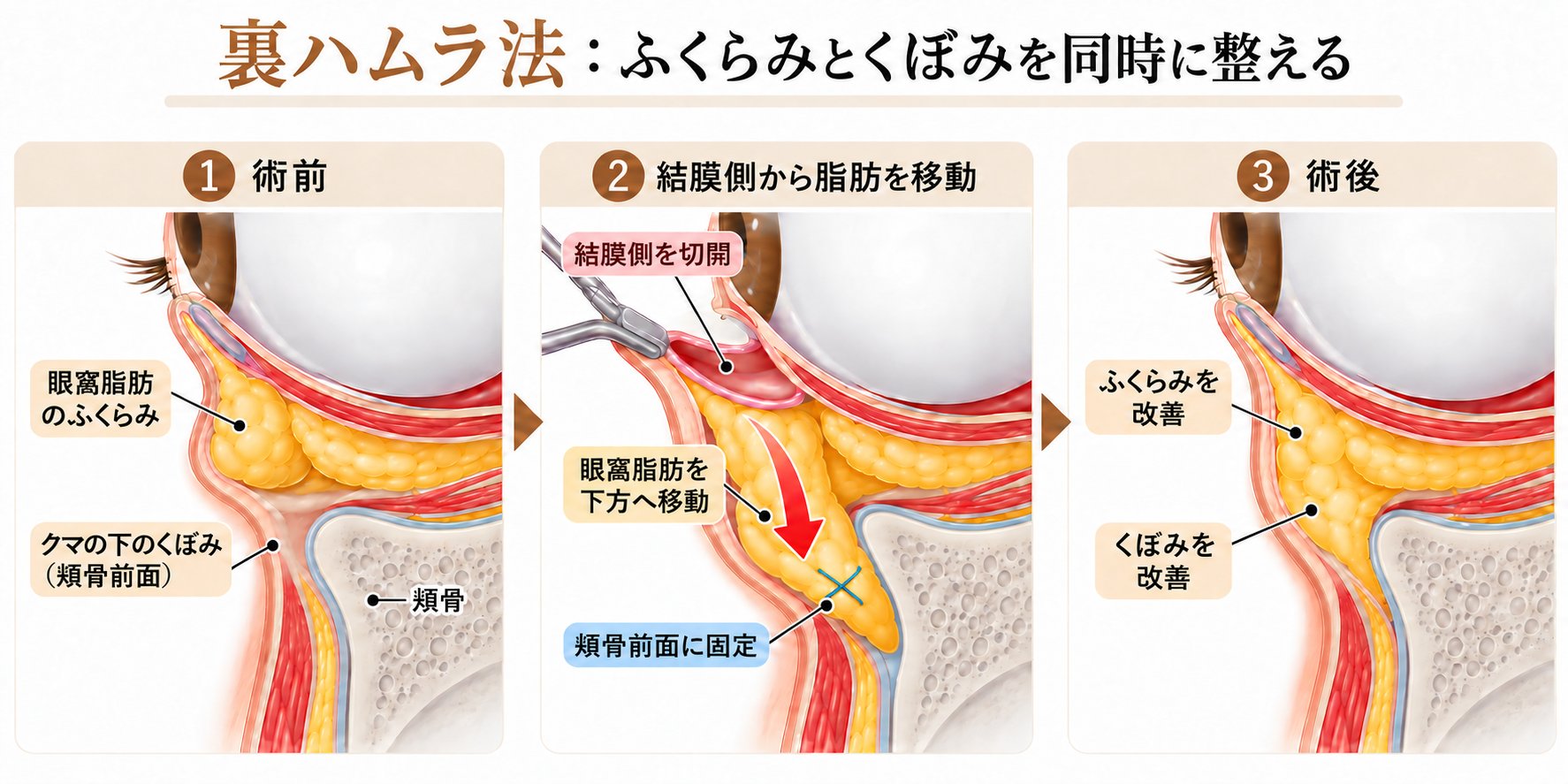 裏ハムラ法の仕組み―眼窩脂肪を移動して骨膜に固定する処置内容