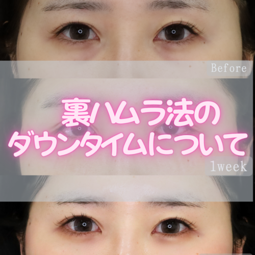 ～裏ハムラのダウンタイムってどのくらい？？🧸～